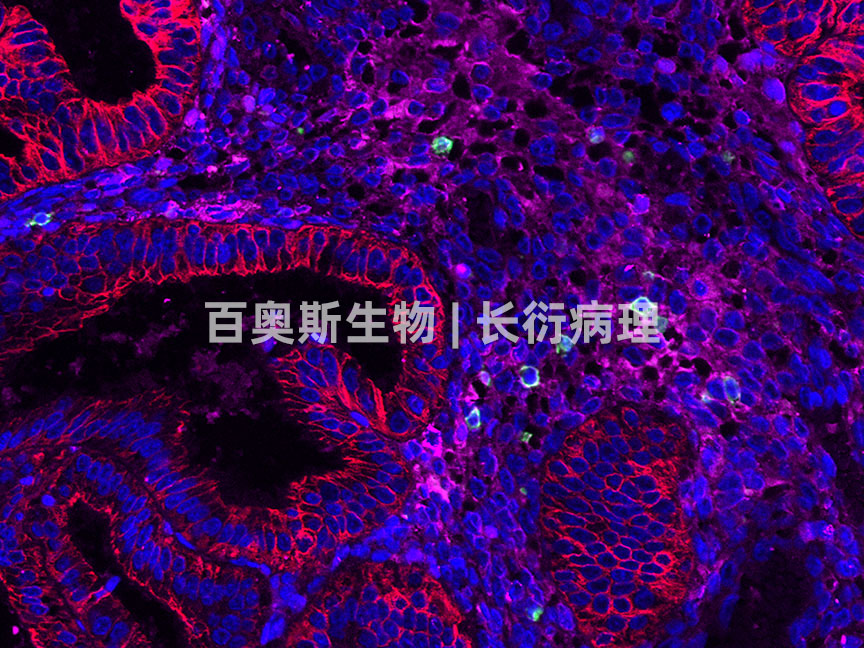 CD3(green)+CK(red)+HLADR(pink)---人-癌组织-350倍---86底板.jpg