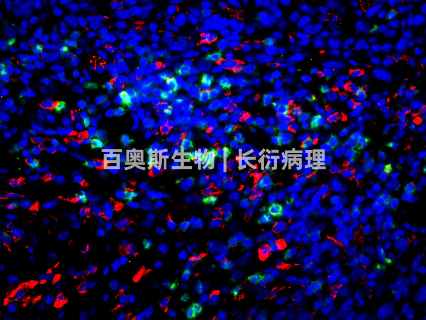 86-CD3(绿)+CD8(红)-肿瘤.jpg